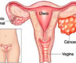 cancer ovario