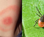 lyme