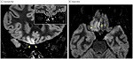 invasión-viral-cerebro-COVID-19-150x67-1