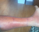 celulitis-pierna